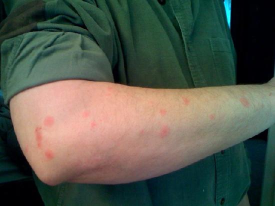 fullerton bed bugs fullerton bed bugs treatment