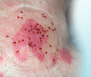 homestead bed bugs homestead bed bugs